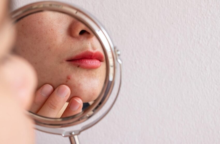 How Do I Know If My Acne Is Fungal? Key Signs to Identify