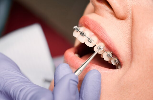 Understanding the Value of Self Ligating Braces in Singapore for Modern Orthodontic Care