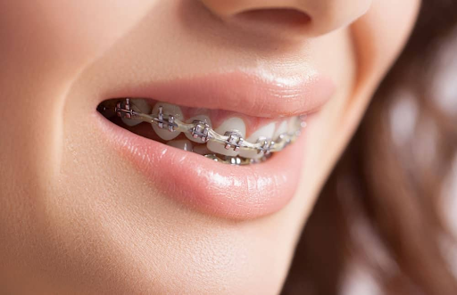 Self-Ligating Braces: A Practical Guide to Treatment in Singapore